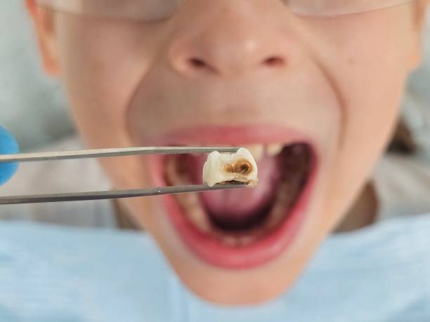 Best Emergency Dental Care for Abscessed Tooth in Severna Park, MD