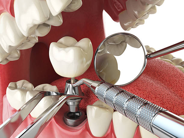Best Emergency Dentist for Lost Fillings or Crowns in Severna Park, MD